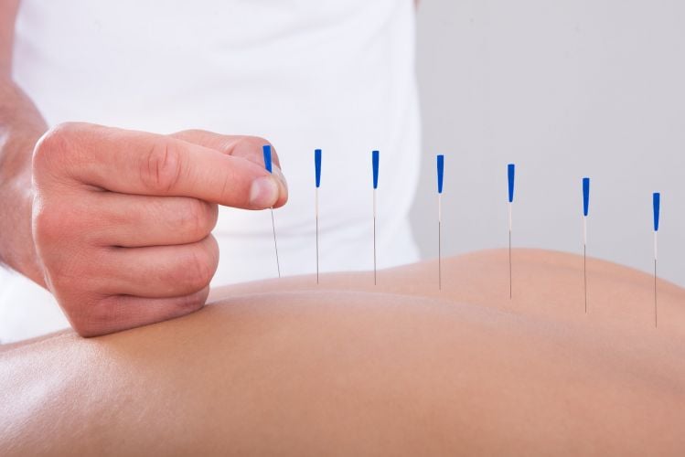 LONDON PHYSIOTHERAPY PRACTITIONER EXPLAINS THE SCIENCE OF ACUPUNCTURE