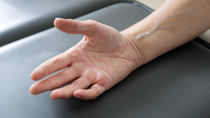 Physiotherapy for Carpal Tunnel Syndrome